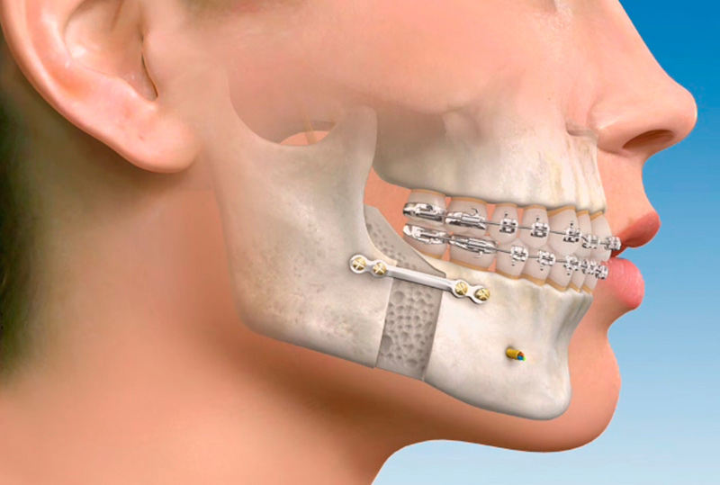 Fotos: estudidentalbarcelona.com cirugia maxilofacial 1