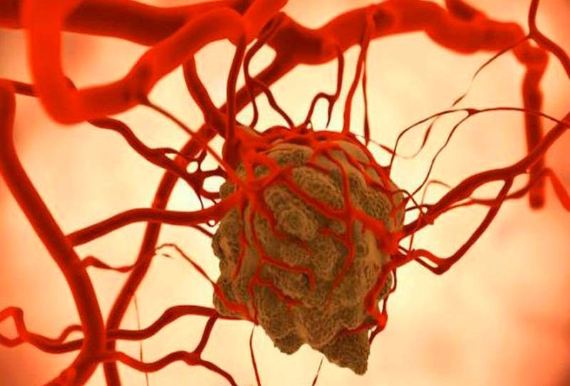 Tumor maligno cuba